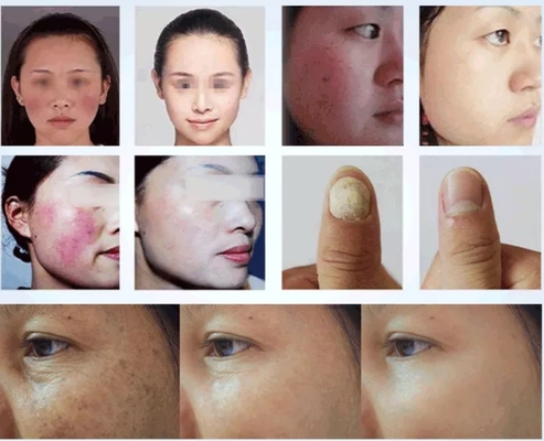 Güzellik Salonu 980nm Diyot Lazer Makinesi Ağrı Kolaylaştırma / Damar Tedavisi