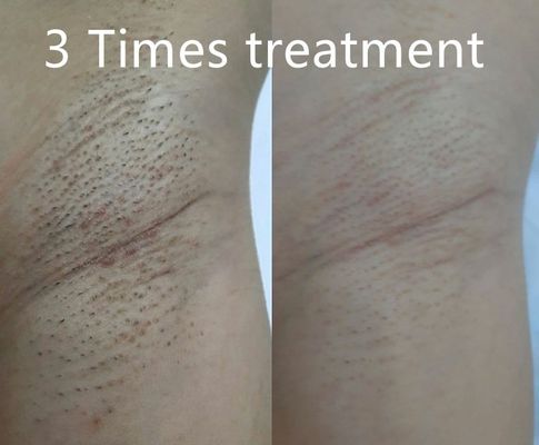 Farklı Kalınlıklarda Kişiye Özel Kalıcı Tüy Azaltma İçin Farklı Darbe Genişliklerini Destekleyen Çok Fonksiyonlu Diyot Lazer Epilasyon Cihazı