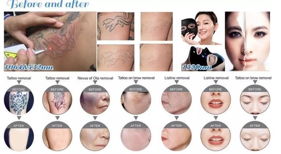 Taşınabilir Nd YAG Lazer Dövme Kaldırma Makinesi 1064nm 532nm 1320nm Dalga Uzunluğu
